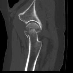 Pipkin Fracture Type 3